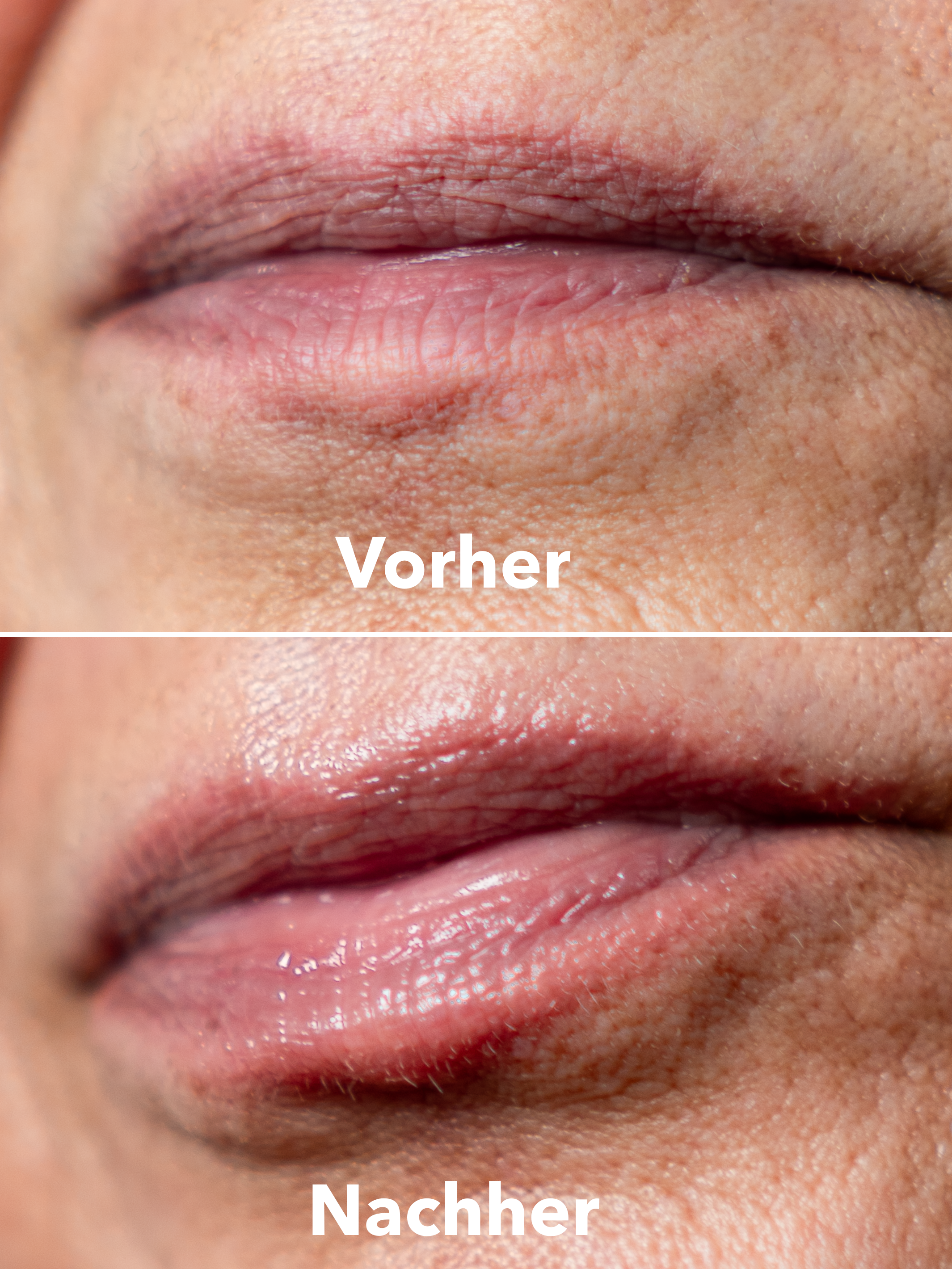 XTREME Lip Herstel