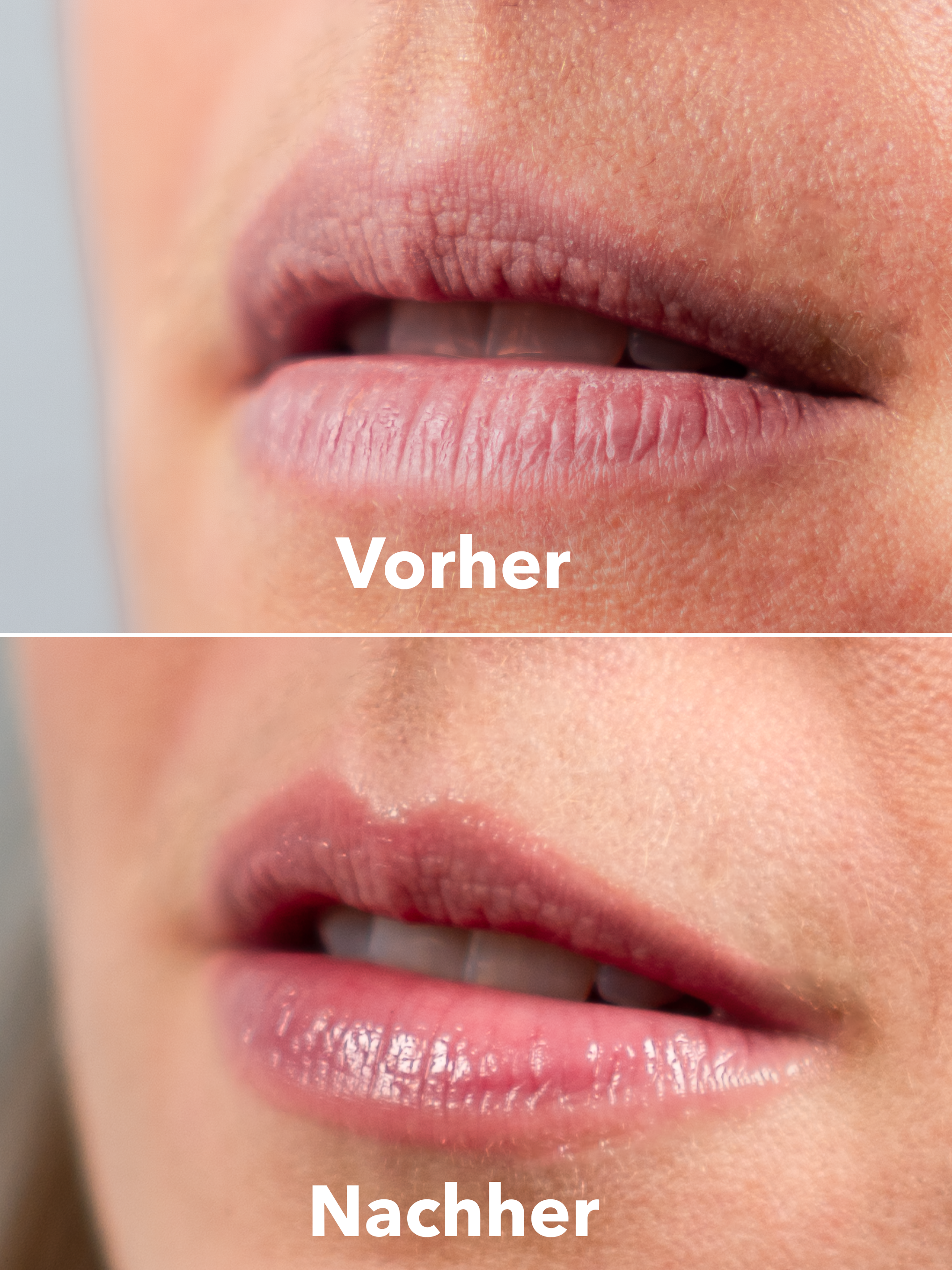 XTREME Lip Herstel