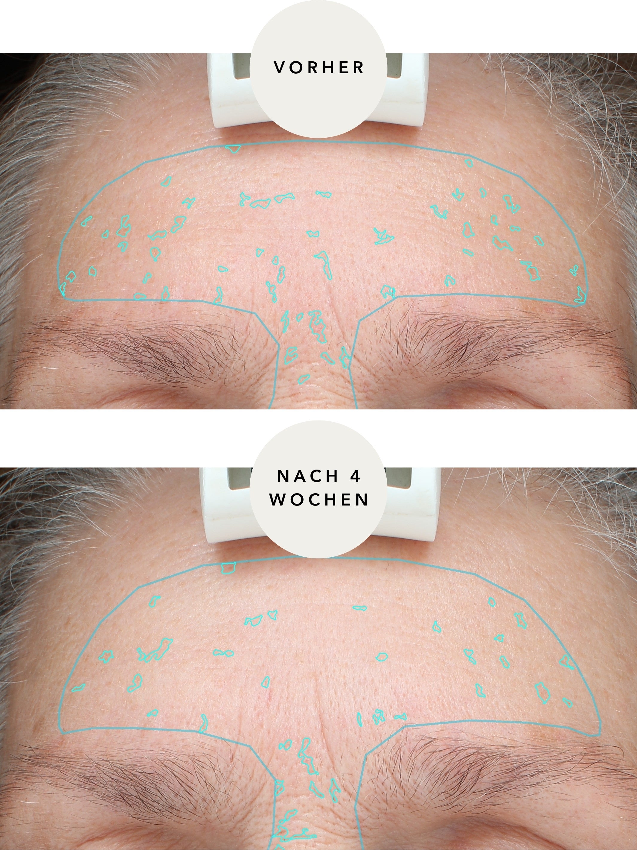Anti-Flecken Handmaske